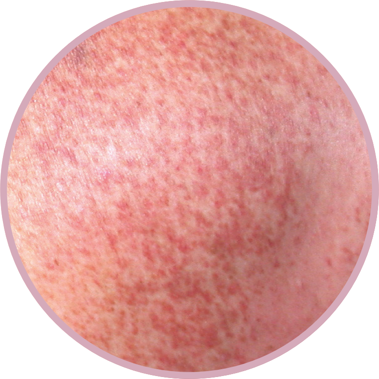 Skin lesion in systemic mastocytosis